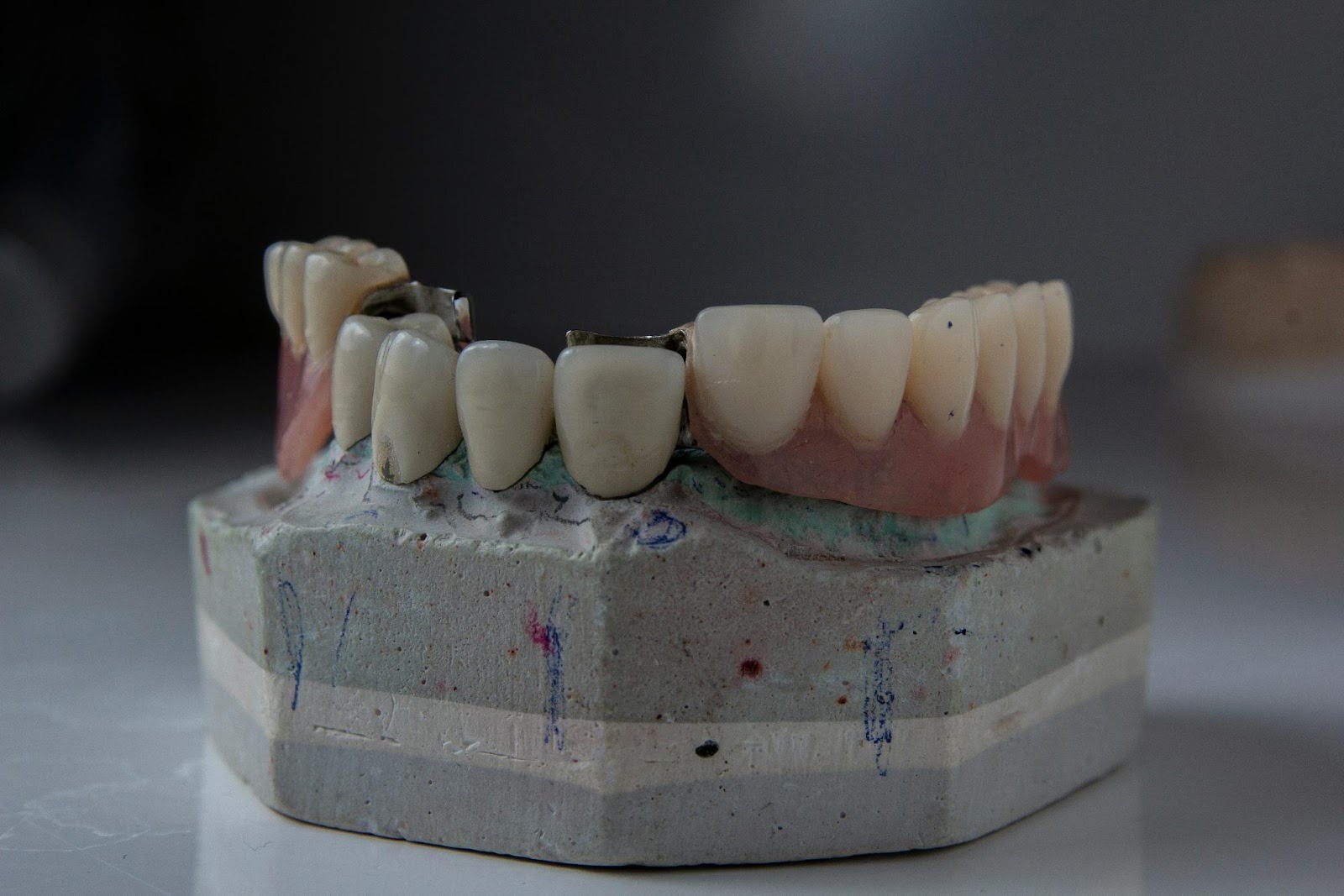 Dental bridge model on a plaster cast, illustrating restorative services that can be promoted through targeted content marketing.