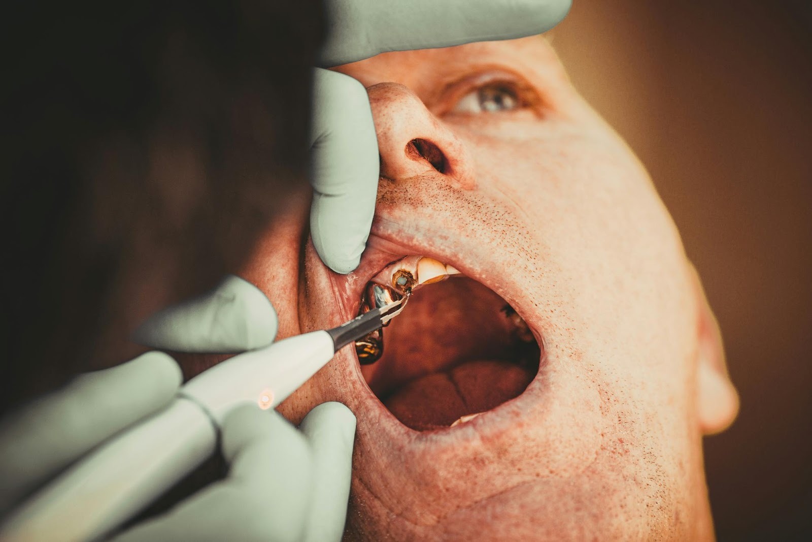 Close-up of tartar removal, used in "before and after" case studies to demonstrate clinical expertise and build trust.